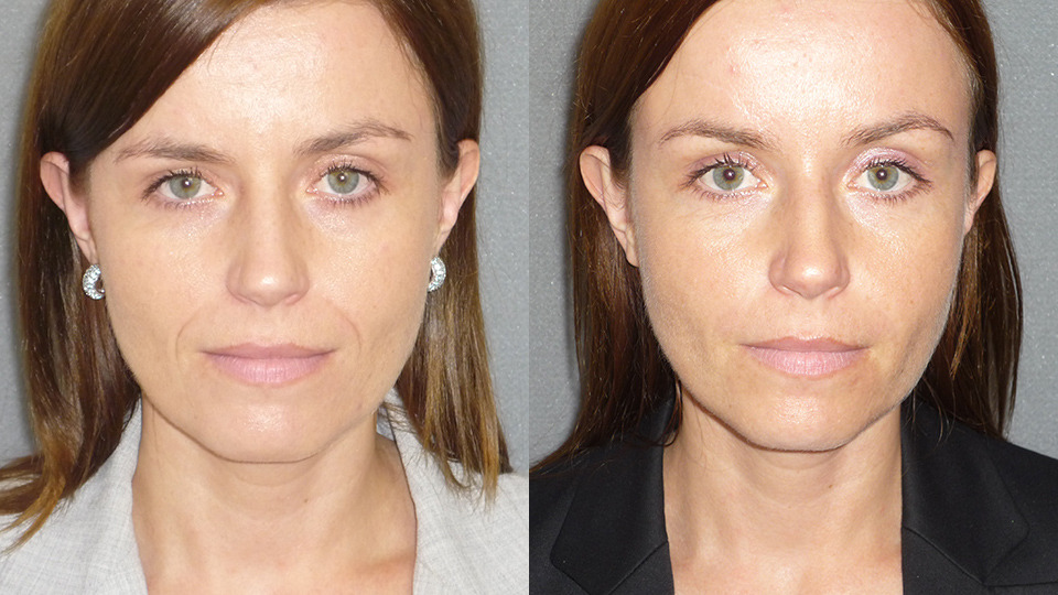 Brow Lift Before and After Photo by Dr. Nguyen in Beverly Hills, CA