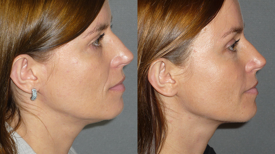 Brow Lift Before and After Photo by Dr. Nguyen in Beverly Hills, CA