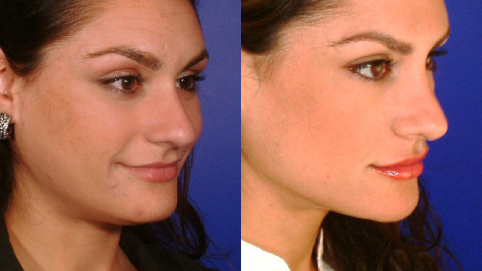 Fillers/Botox Before and After Photo by Dr. Nguyen in Beverly Hills, CA