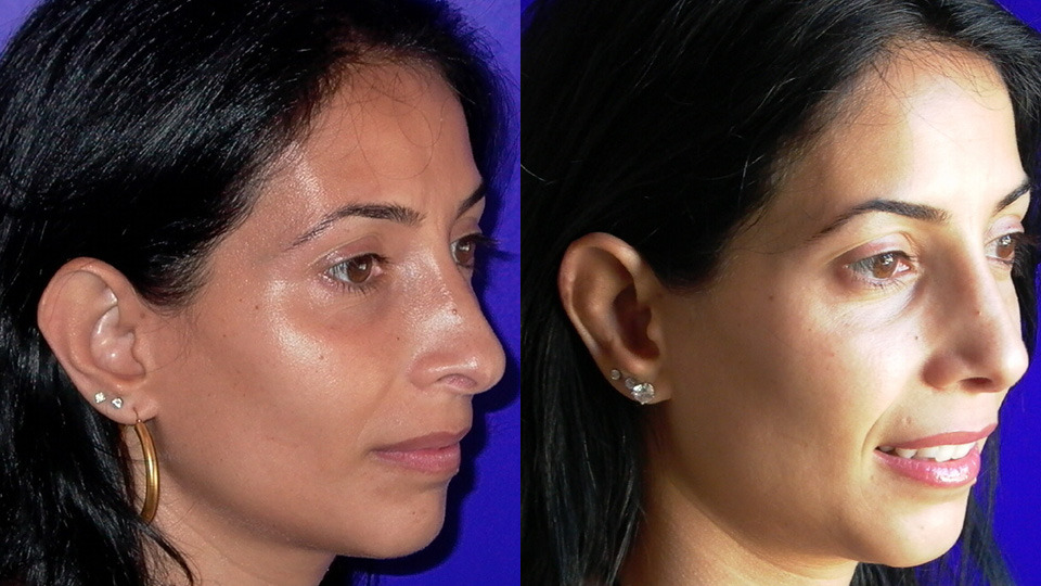 Otoplasty Before and After Photo by Dr. Nguyen in Beverly Hills, CA
