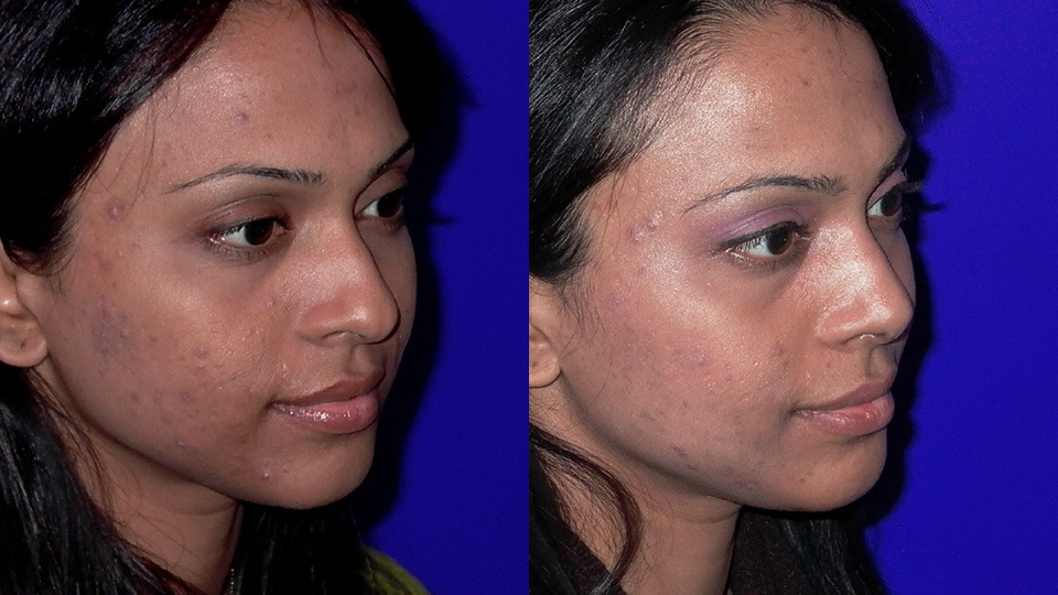 Rhinoplasty Before and After Photo by Dr. Nguyen in Beverly Hills, CA