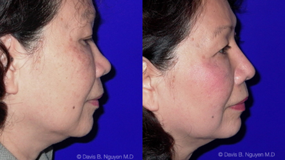 Rhinoplasty Before and After photo by Davis B. Nguyen, M.D. in Beverly Hills, CA
