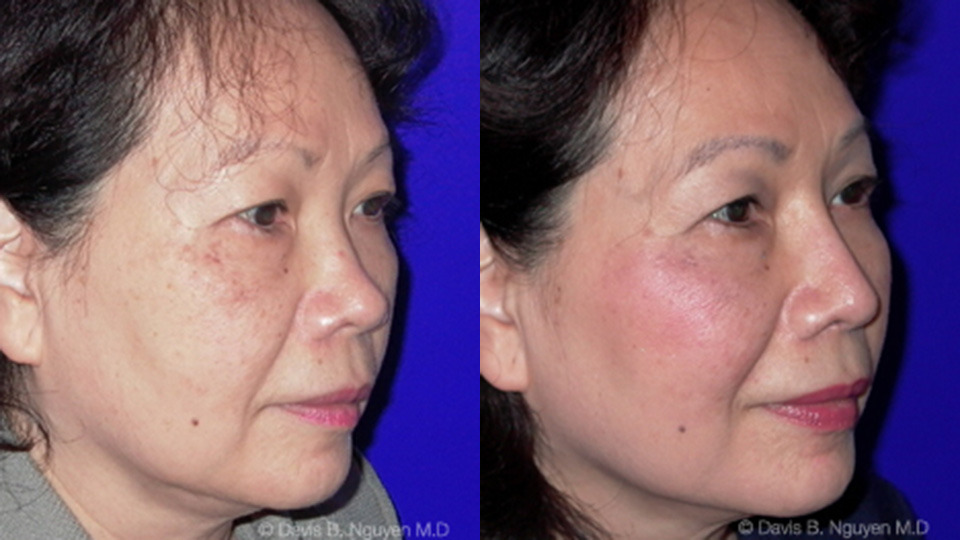 Rhinoplasty Before and After photo by Davis B. Nguyen, M.D. in Beverly Hills, CA