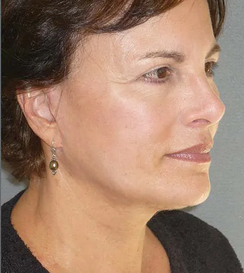 Facelift Results Beverly Hills