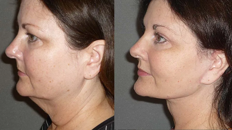 Brow Lift Before and After photo by Davis B. Nguyen, M.D. in Beverly Hills, CA