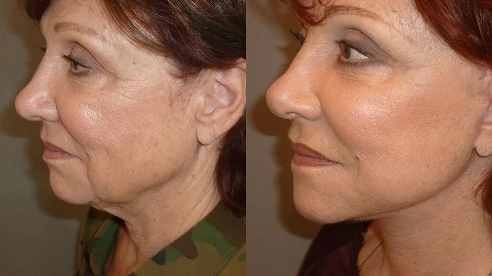 Eyelid Lift Before and After photo by Davis B. Nguyen, M.D. in Beverly Hills, CA