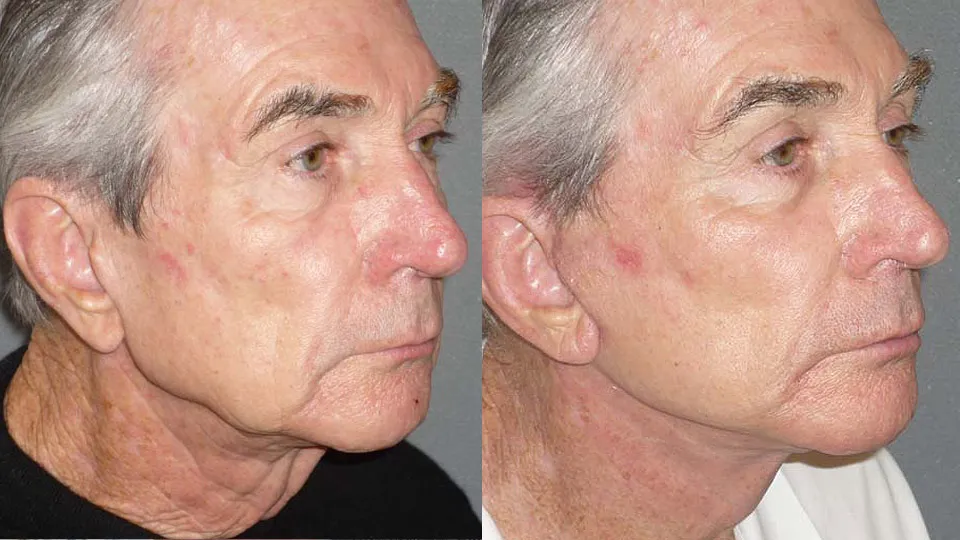 Eyelid Lift Before and After photo by Davis B. Nguyen, M.D. in Beverly Hills, CA