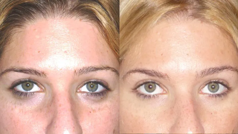 Fillers/Botox Before and After photo by Davis B. Nguyen, M.D. in Beverly Hills, CA