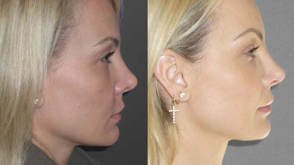 Fillers/Botox Before and After photo by Davis B. Nguyen, M.D. in Beverly Hills, CA