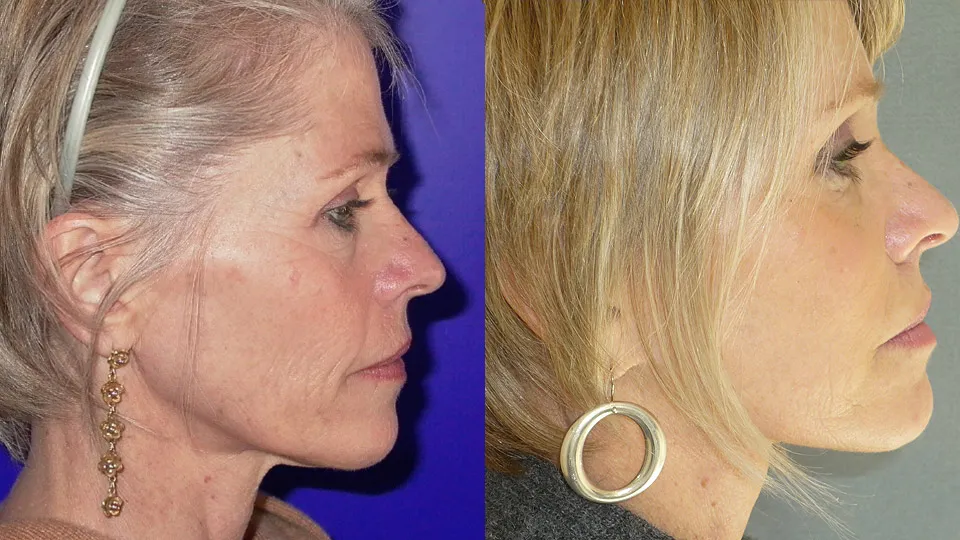 Laser Skin Rejuvenation Before and After photo by Davis B. Nguyen, M.D. in Beverly Hills, CA