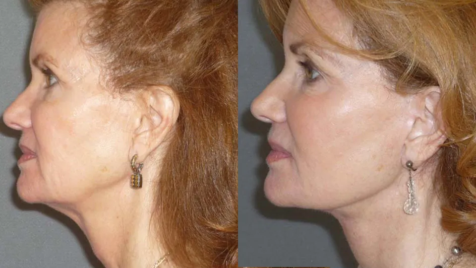 Laser Skin Rejuvenation Before and After photo by Davis B. Nguyen, M.D. in Beverly Hills, CA