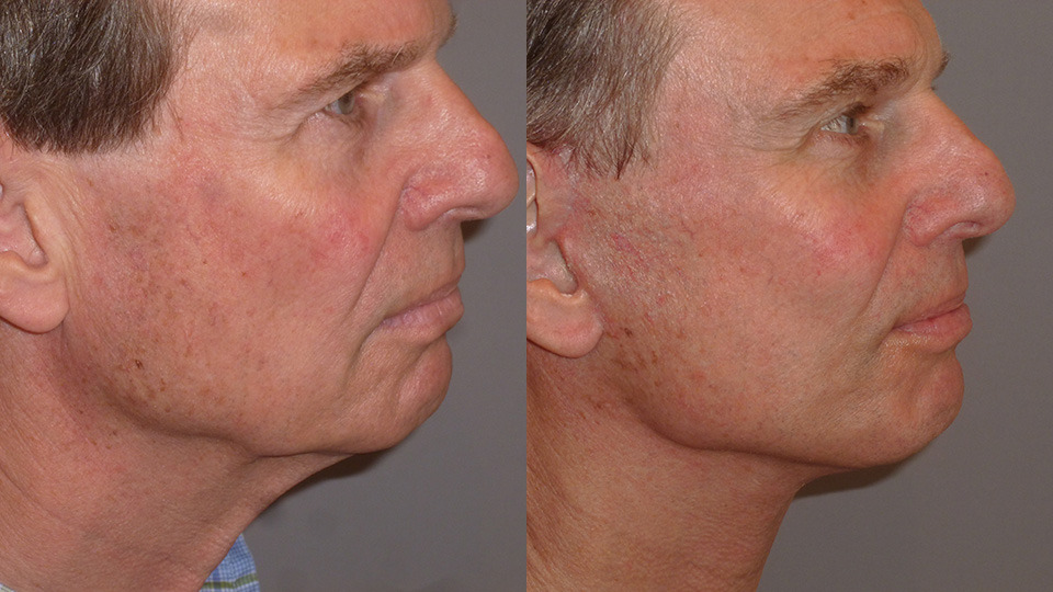 Eyelid Lift Before and After Photo by Dr. Nguyen in Beverly Hills, CA