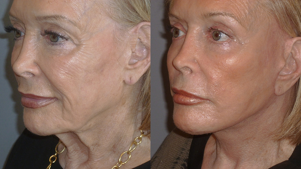 Eyelid Lift Before and After Photo by Dr. Nguyen in Beverly Hills, CA