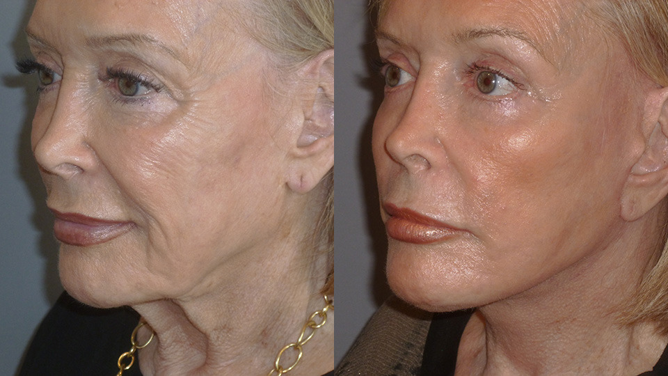 Facelift and Necklift Before and After photo by Davis B. Nguyen, M.D. in Beverly Hills, CA