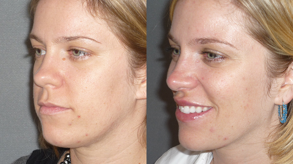 Facial Liposculpting Before and After Photo by Dr. Nguyen in Beverly Hills, CA