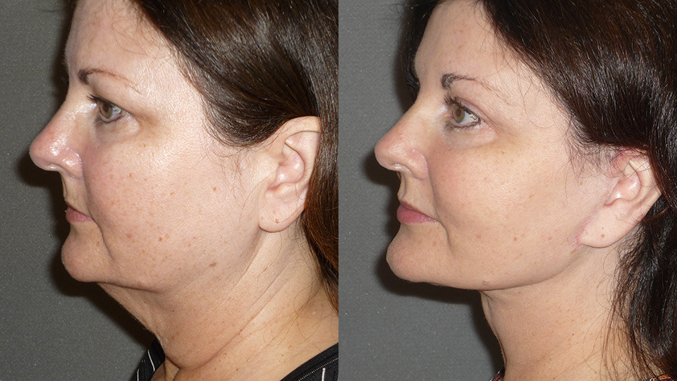 Facial Liposculpting Before and After Photo by Dr. Nguyen in Beverly Hills, CA