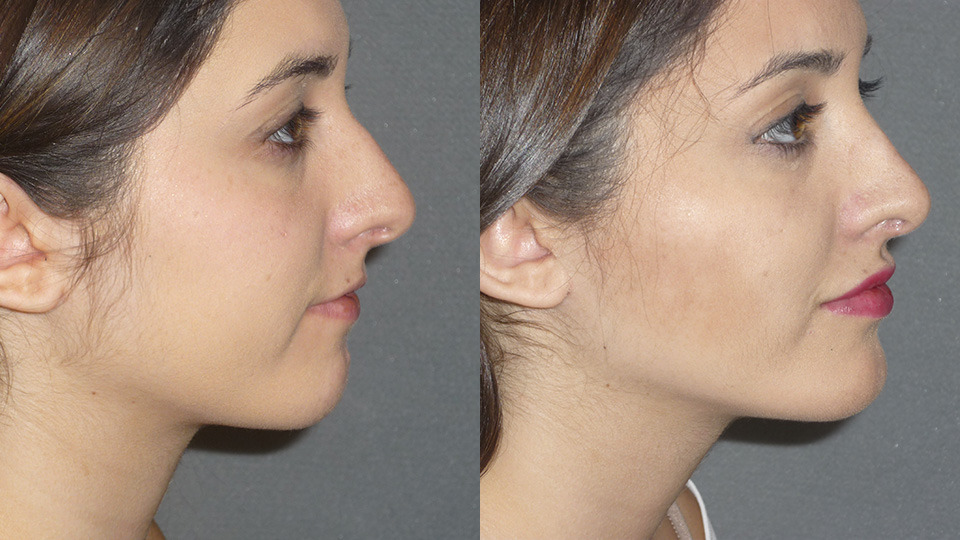 Fillers/Botox Before and After Photo by Dr. Nguyen in Beverly Hills, CA
