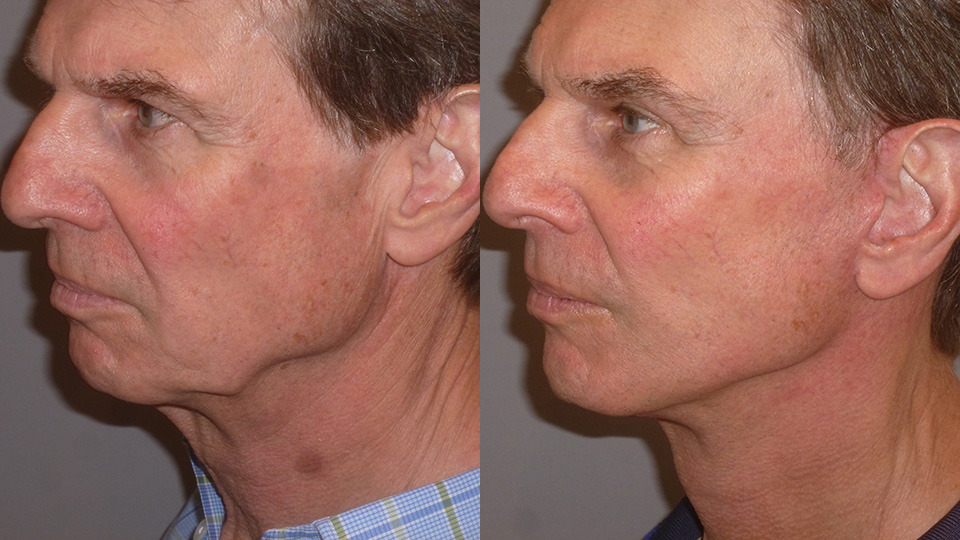 Facelift & Neck Lift Before and After Photo by Dr. Nguyen in Beverly Hills, CA