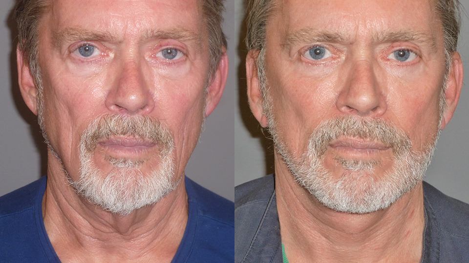 Facelift & Neck Lift Before and After Photo by Dr. Nguyen in Beverly Hills, CA
