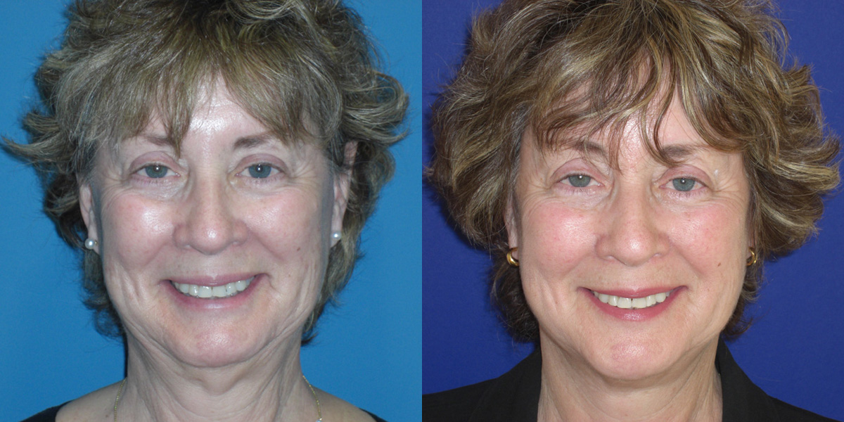Facelift and Necklift Before and After photo by Davis B. Nguyen, M.D. in Beverly Hills, CA
