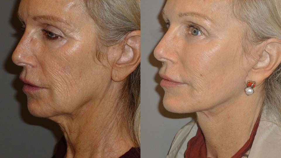 Facelift and Necklift Before and After Photo by Dr. Nguyen in Beverly Hills, CA