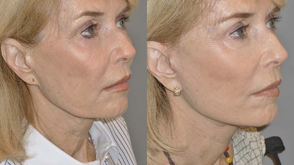 Facelift and Necklift Before and After Photo by Dr. Nguyen in Beverly Hills, CA