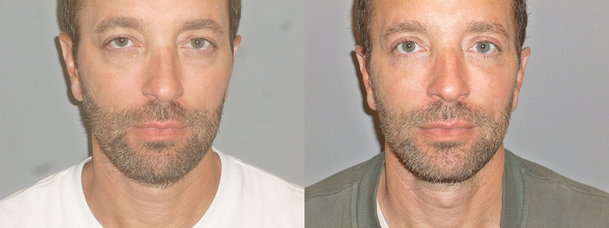 Skin Rejuvenation Lasers Before and After Photo by Dr. Nguyen in Beverly Hills, CA