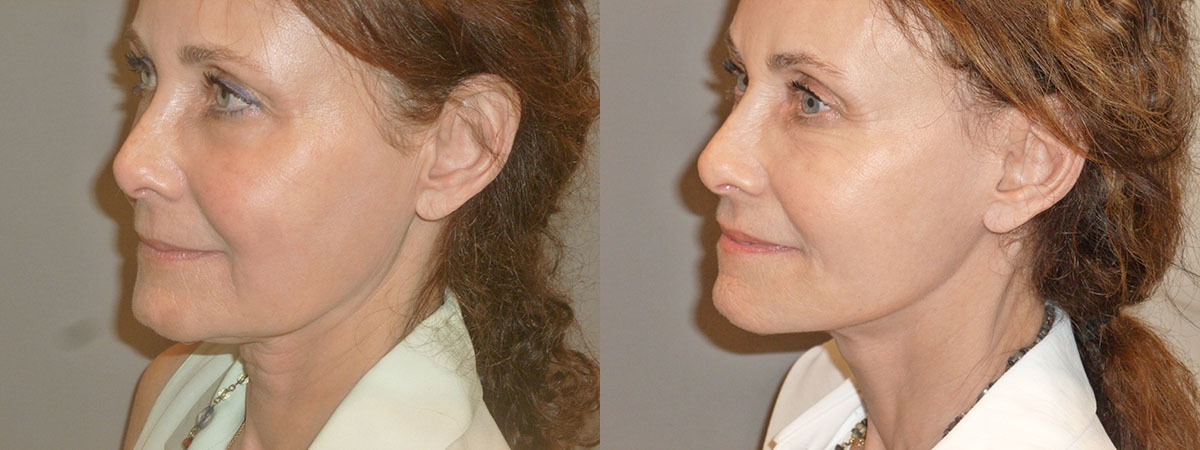 Face/Necklift Before and After Photo by Dr. Nguyen in Beverly Hills, CA