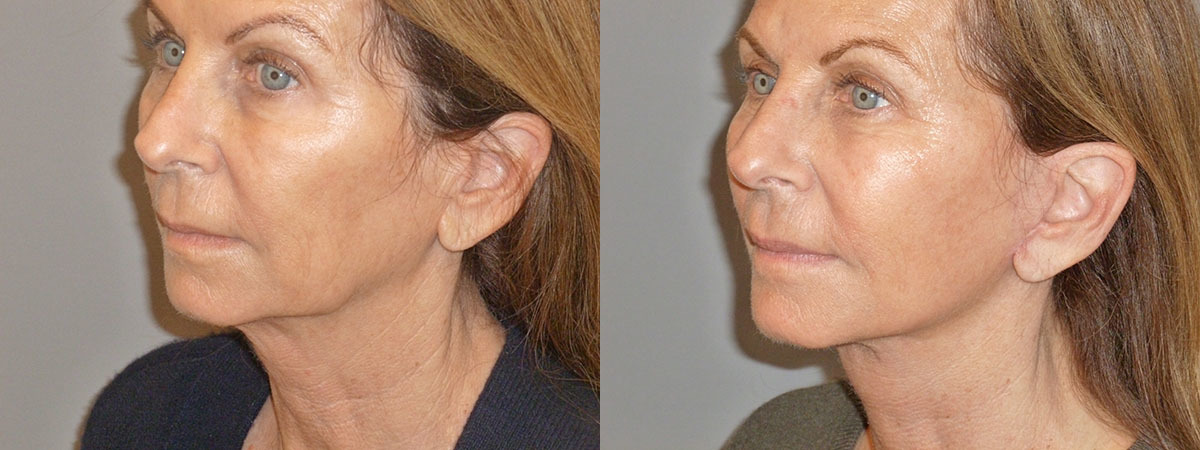 Eyelift Before and After Photo by Dr. Nguyen in Beverly Hills, CA