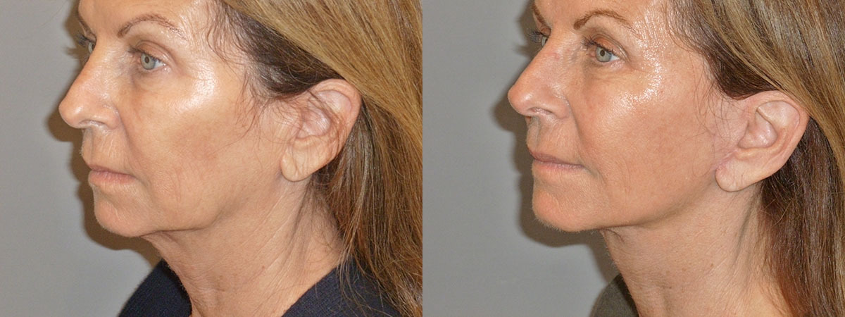 Eyelift Before and After Photo by Dr. Nguyen in Beverly Hills, CA
